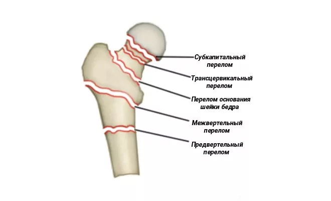 перелом шейки бедра